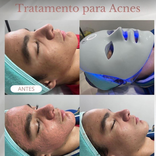 Tratamento facial